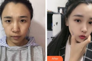 山西省眼科醫(yī)院魏彤心整形價格表附眼部綜合案例展示