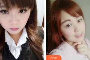 蘭州市口腔醫(yī)院陳景宜整形價格表附牙齒矯正案例展示