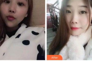 太原時光整形美容醫(yī)院洪愷志整形價格表附根管調節(jié)案例展示