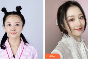 貴陽(yáng)利美康醫(yī)院朱莉芳整形價(jià)格表附植發(fā)案例展示