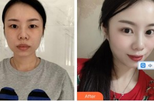 太原晉綺醫(yī)療美容診所蘇育臺整形價格表附眼部綜合案例展示