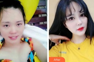 太原美媛薈整形美容醫(yī)院弓軍勝整形價格表附眼部綜合案例展示