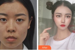 太原美媛薈整形美容醫(yī)院馮瑞錚整形價格表附眼部綜合案例展示