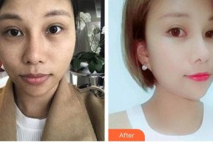 太原德爾美客醫(yī)療美容診所李文暉整形價格表附激光美膚激光案例展示