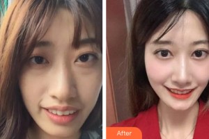 貴陽美和諧醫(yī)療美容門診部陳明整形價格表附牙齒矯正案例展示