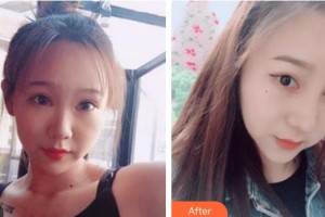 太原愛爾眼科醫(yī)院郝艷君整形價(jià)格表附切開雙眼皮案例展示