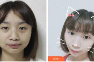太原時光整形美容醫(yī)院席曉云整形價格表附埋線提升案例展示