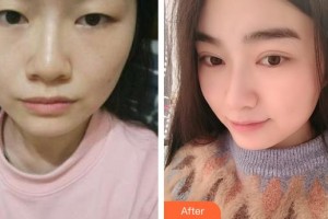 太原星范醫(yī)療美容門診部蘭秀琴整形價(jià)格表附眼部修復(fù)案例展示