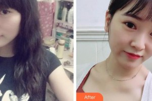 大同解放軍322醫(yī)院醫(yī)學(xué)整形美容中心朱清海整形價(jià)格表附切開雙眼皮案例展示