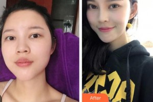 大同美神整形美容醫(yī)院王智麒整形價(jià)格表附鼻部綜合案例展示