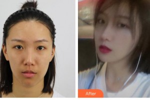 大同鳳凰婦產(chǎn)醫(yī)院整形美容科王艷波整形價(jià)格表附耳軟骨復(fù)合隆鼻案例展示