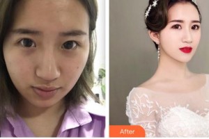 大同清木整形醫(yī)院張樹霞整形價(jià)格表附埋線提升案例展示