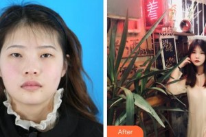 長(zhǎng)治天成醫(yī)療美容診所董琪整形價(jià)格表附眼部綜合案例展示