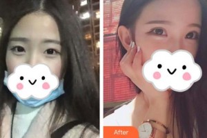 晉城市眼科醫(yī)院張莉整形價(jià)格表附定點(diǎn)雙眼皮案例展示