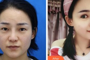 晉城星范醫(yī)療美容診所崔雅寧整形價格表附眼部綜合案例展示