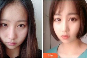 晉城現(xiàn)代女子醫(yī)院整形美容中心張建強整形價格表附外切祛眼袋案例展示