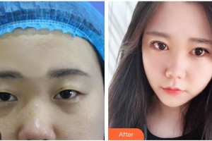 朔州麗都醫(yī)療整形美容醫(yī)院梁榮生整形價格表附切開雙眼皮案例展示