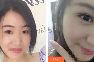 晉中鷹華眼科醫(yī)院王生英整形價(jià)格表附切開雙眼皮案例展示