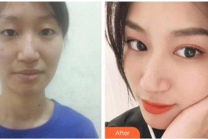 運城光子醫(yī)療美容門診部李守義整形價格表附眼部綜合案例展示