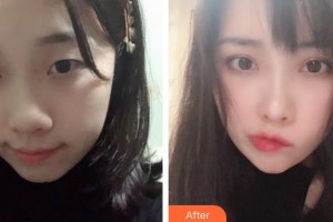運城薛大夫整形美容門診部李彬整形價格表附眼部綜合案例展示