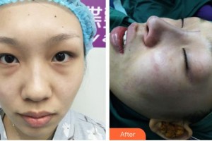 運城華美醫(yī)學美容醫(yī)院劉安堂整形價格表附耳軟骨復合隆鼻案例展示