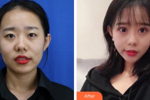 三亞瑞希醫(yī)學美容門診部方輝技術(shù)院長整形價格表附眼部手術(shù)案例展示