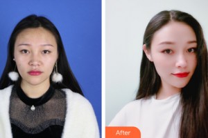 三亞維多利亞醫(yī)療美容醫(yī)院李志偉整形價格表附鼻部手術案例展示