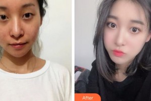 運城愛爾眼科醫(yī)院劉斌虎整形價格表附開內眼角案例展示