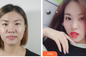 運(yùn)城愛(ài)爾眼科醫(yī)院寧英慧整形價(jià)格表附切開雙眼皮案例展示
