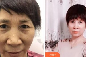 運城市眼科醫(yī)院黃淑芳整形價格表附切眉術案例展示