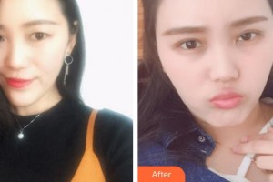 臨汾麗都整形美容門診部趙曉剛整形價(jià)格表附眼部綜合案例展示