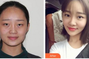 內(nèi)蒙古榮軍醫(yī)院整形美容科張啟凌整形價格表附光子嫩膚案例展示