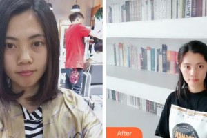 內(nèi)蒙古佳麗醫(yī)療美容診所張振林整形價(jià)格表附光子嫩膚案例展示