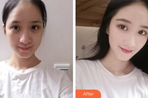 呼和浩特伊思整形?？漆t(yī)院白莉整形價格表附紅藍(lán)光祛痘案例展示