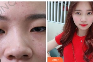 呼和浩特任榮大韓醫(yī)療美容診所劉豪整形價(jià)格表附埋線雙眼皮案例展示