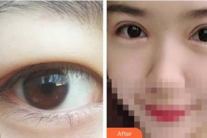呼和浩特維科美容整形診所辛來(lái)整形價(jià)格表附切開雙眼皮案例展示