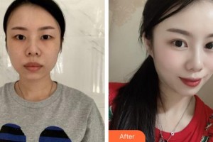 呼和浩特朝聚眼科醫(yī)院艾育德整形價格表附切開雙眼皮案例展示