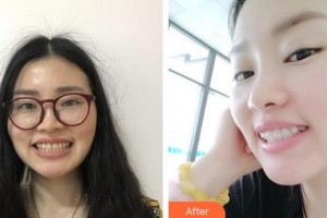 呼和浩特董志新口腔門診部賽吉亞整形價格表附金屬托槽矯正案例展示