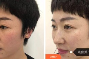 包頭麗人婦產醫(yī)院醫(yī)學美容科孫武堅整形價格表附去痘印痘坑例展示