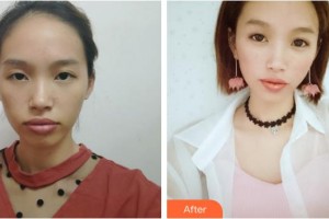 赤峰現(xiàn)代婦產(chǎn)醫(yī)院醫(yī)療美容科朱莉整形價格表附鼻部綜合案例展示