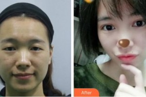 通遼京韓創(chuàng)美醫(yī)療美容診所子墨整形價(jià)格表附切開(kāi)雙眼皮案例展示