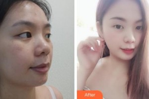 吉林大學(xué)第一醫(yī)院整形美容科張舵整形價(jià)格表附無(wú)針?biāo)獍咐故?>
</a>
<h3 class=