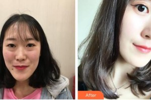長(zhǎng)春韓一美容醫(yī)院樸明旭整形價(jià)格表附眼部綜合案例展示