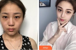 長(zhǎng)春奧拉克美容醫(yī)院鄭瑩整形價(jià)格表附假體隆鼻案例展示