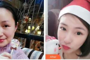 長春正韓醫(yī)療美容醫(yī)院齊峰整形價格表附埋線提升案例展示