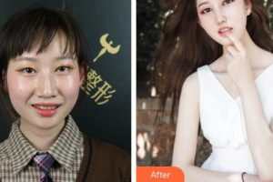 四平市燒傷整形醫(yī)院王國(guó)才整形價(jià)格表附牙齒隱形矯正案例展示