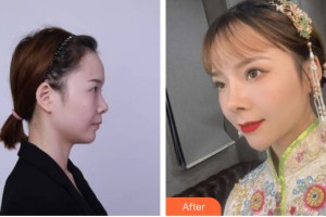 義烏張小紅醫(yī)療美容醫(yī)院張小紅整形價格表附隆鼻手術(shù)案例展示
