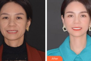 義烏歐萊美醫(yī)療美容醫(yī)院劉衛(wèi)國整形價格表附牙齒矯正案例展示