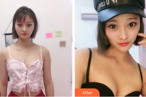 寧夏自然醫(yī)學(xué)美容診所柴永民整形價格表附隆胸手術(shù)案例展示