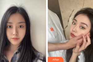 寧夏自然醫(yī)學(xué)美容診所石海鷹整形價格表附眼部手術(shù)案例展示